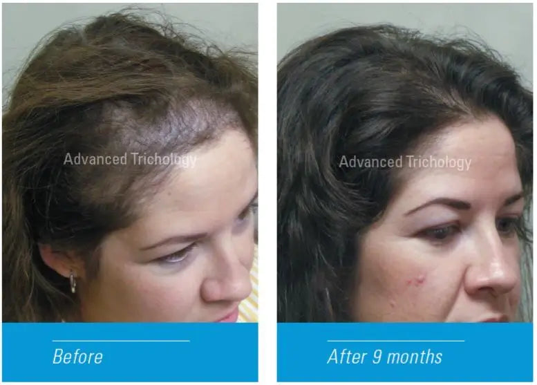 FoliGROWTH Ultimate Hair Nutraceutical