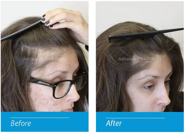 FoliGROWTH Ultimate Hair Nutraceutical