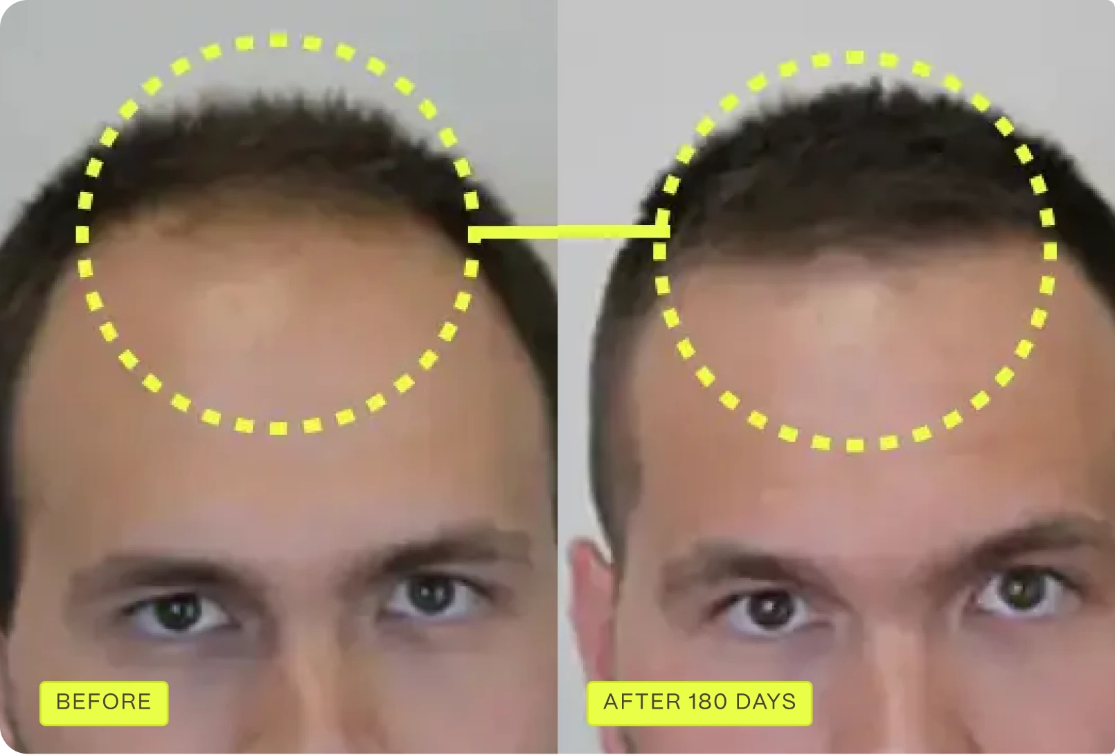 Before and after 180 days