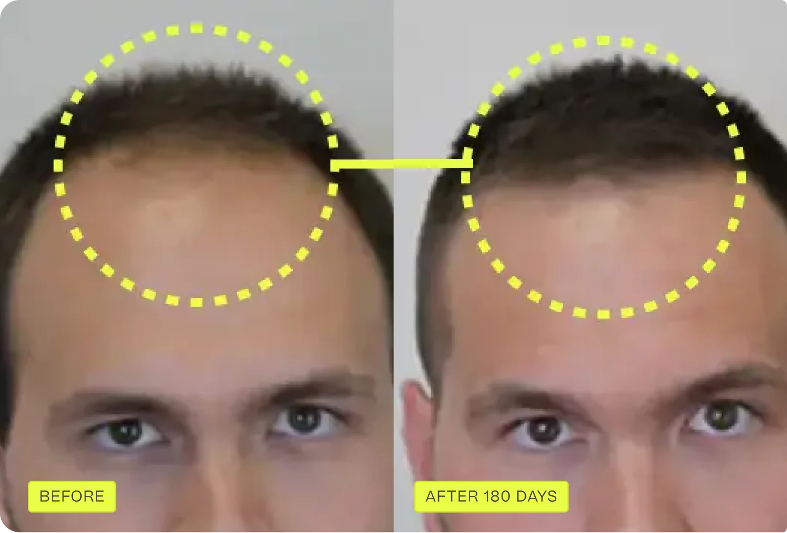 Before and after 180 days