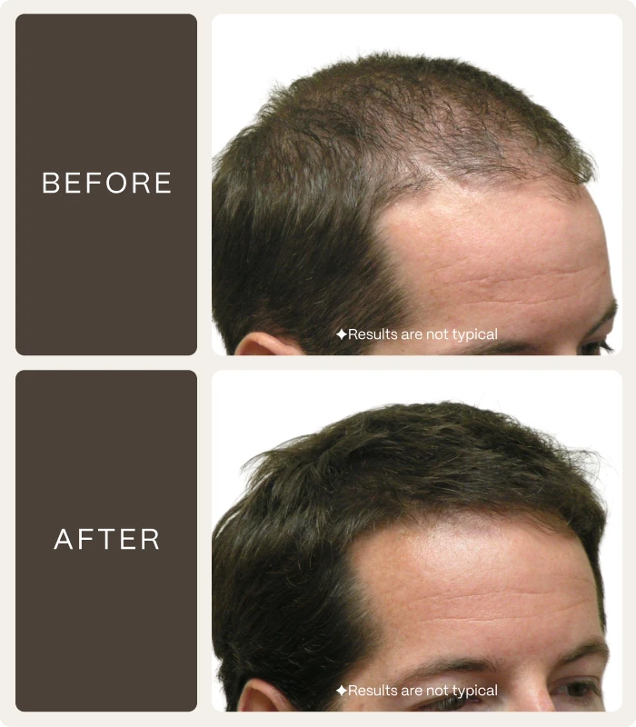 Before — ✦Results are not typical — After