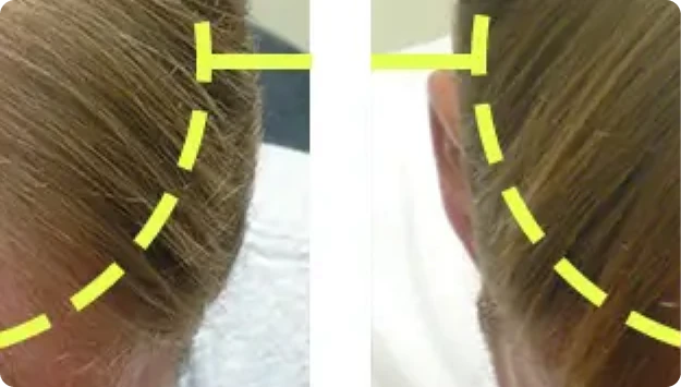 Before and after: close-up of light brown hair at the side of the head, thinner before and fuller after