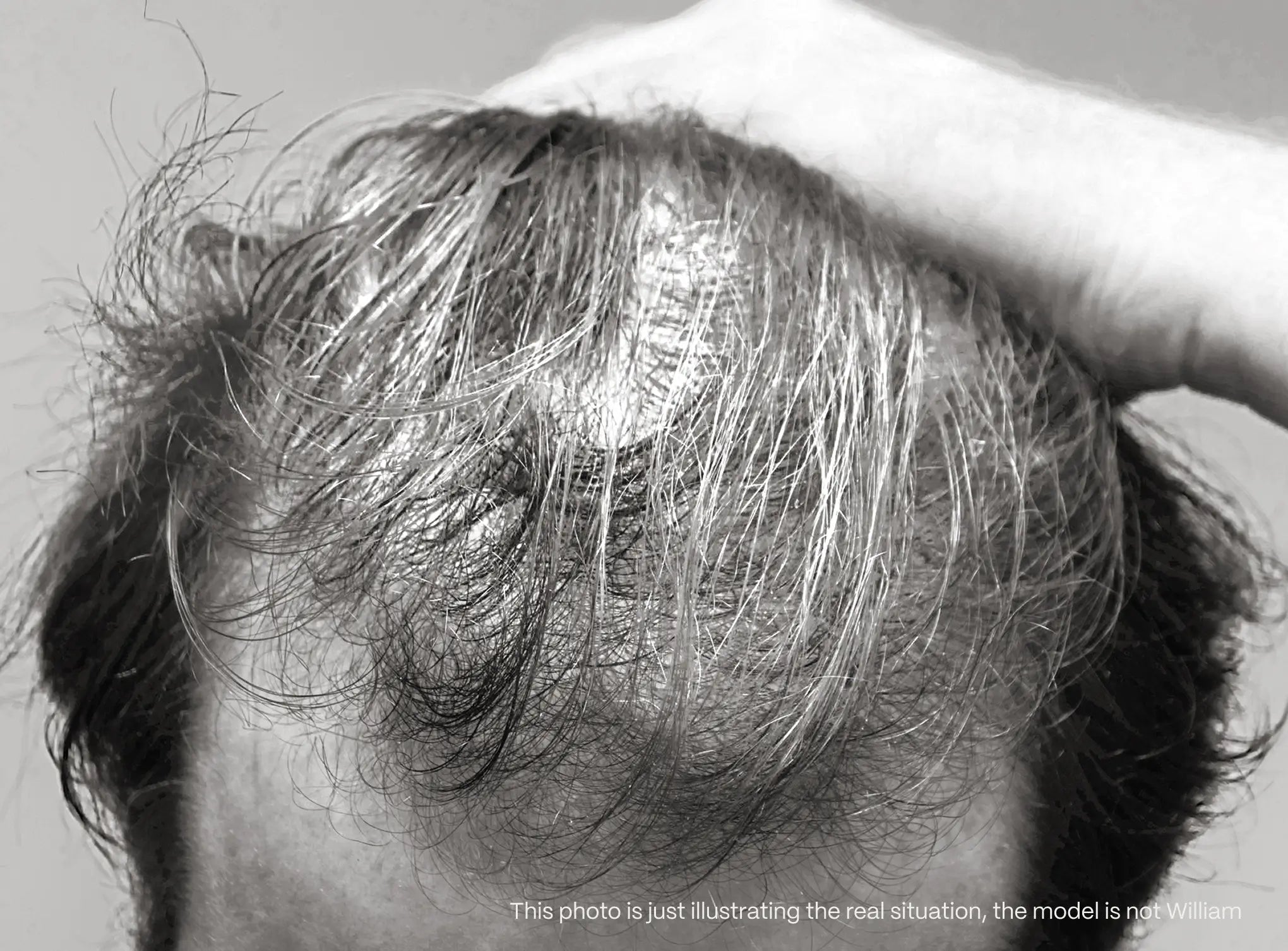 Black-and-white photo of a thinning crown. This photo illustrates the situation; the model is not William.