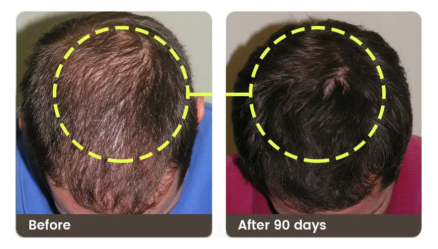 Before and after 90 days: the crown of a man’s head, top-down, thinner before and denser after