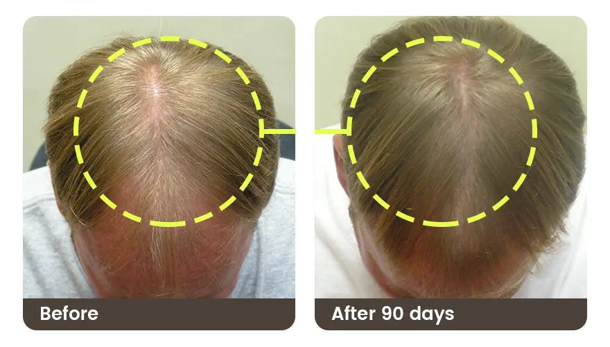 Before and after 90 days: the top of the head, thinner before and denser after