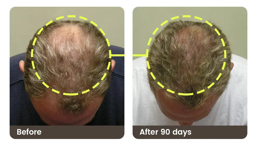 Before and after 90 days: the crown of a man’s head, top-down, thinner before and denser after