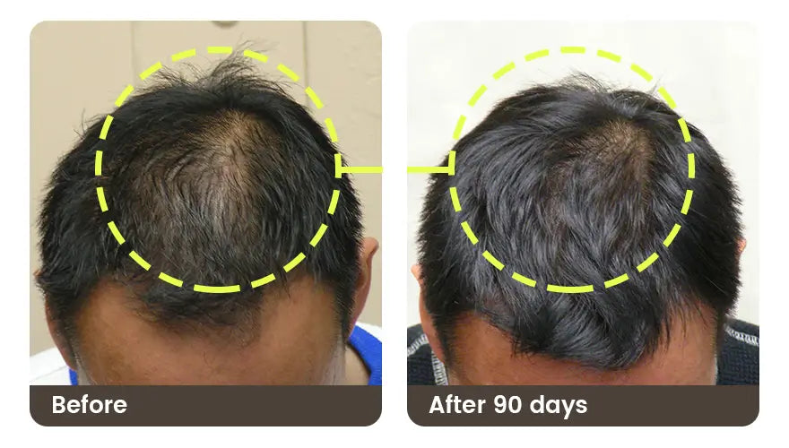 Before and after 90 days: the crown of a man’s head, top-down, thinner before and denser after