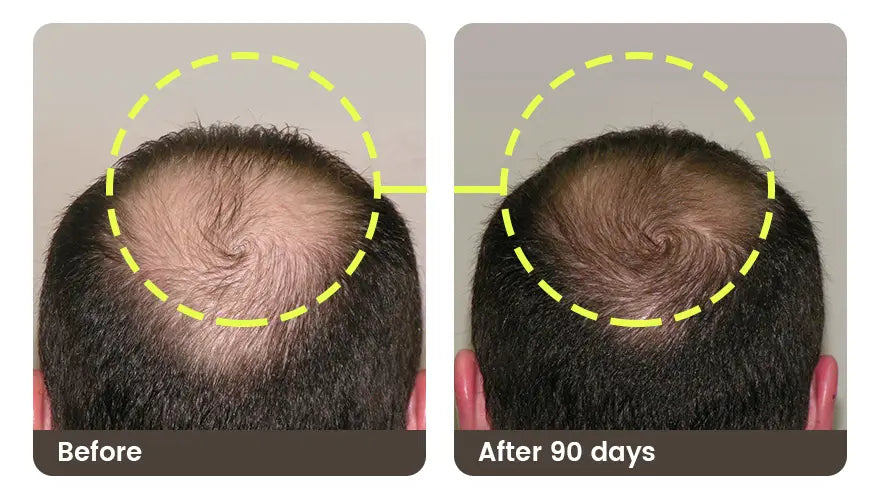 Before and after 90 days: the crown of a man’s head, with a visible thin spot before and more coverage after