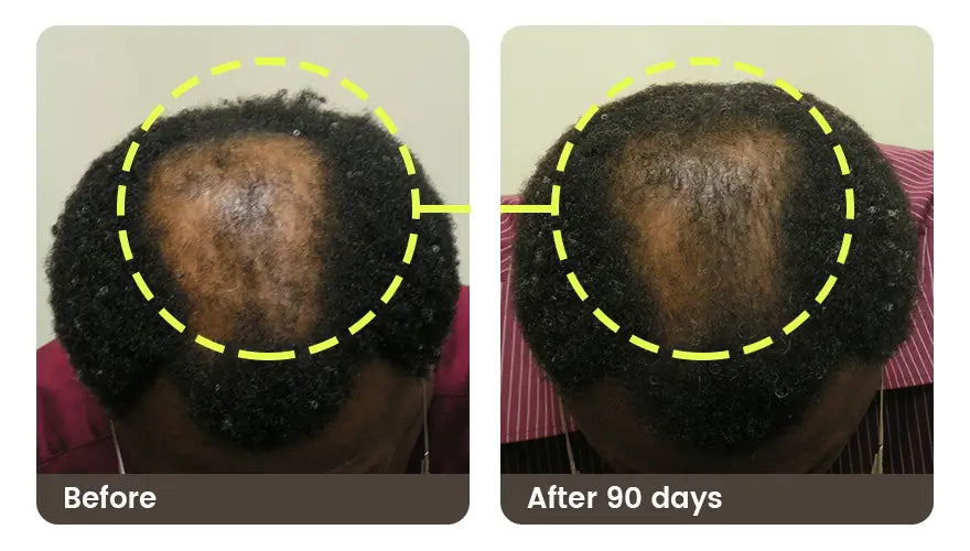 Before and after 90 days: the crown of a man’s head, with a visible bald patch before and more coverage after