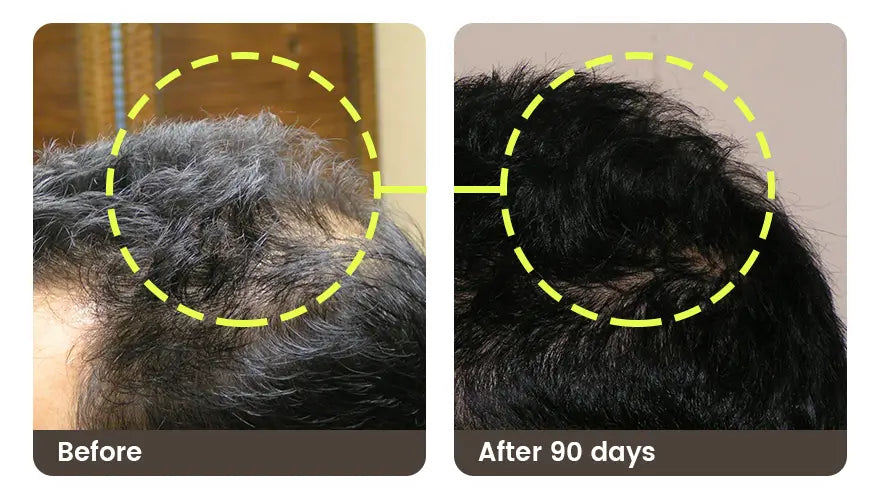 Before and after 90 days: the top of the head from the side, thinner before and fuller after