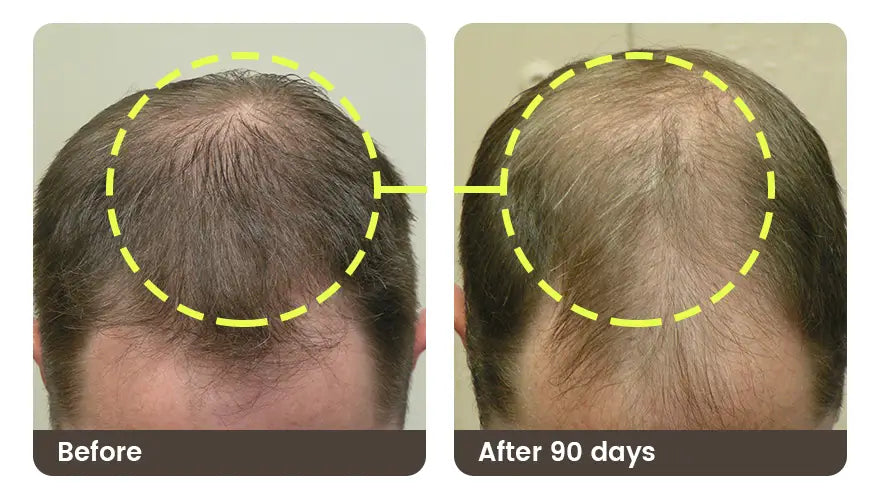 Before and after 90 days: the front and top of a man’s head, thinner before and fuller after