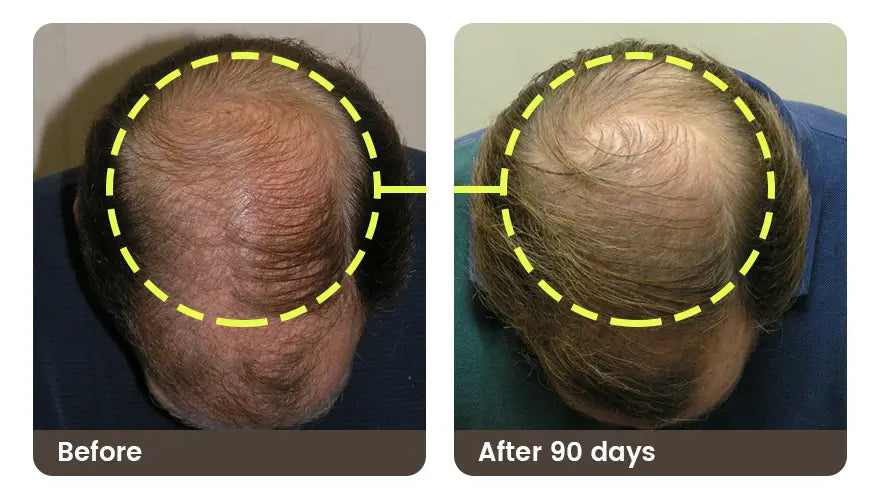 Before and after 90 days: the crown of a man’s head, mostly bald before and with more hair after