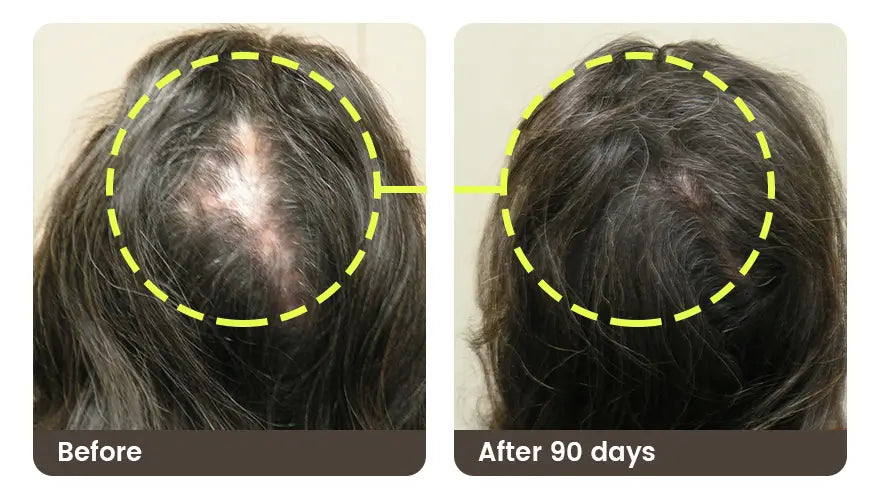 Before and after 90 days: the top of a woman’s head, with a widening part before and fuller hair after