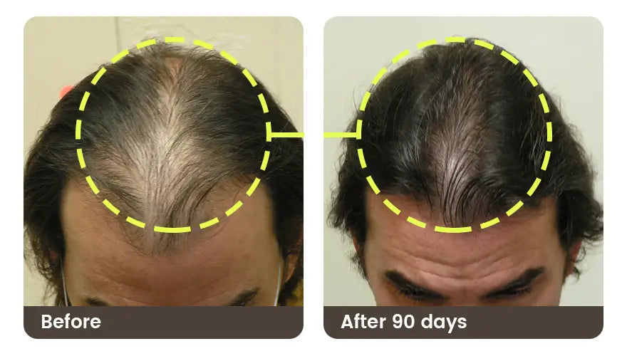 Before and after 90 days: a man’s front hairline, thinning before and fuller after