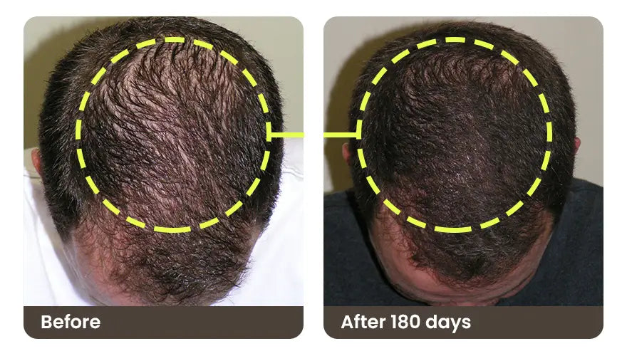 Before and after 180 days: the crown of a man’s head, top-down, thinner before and denser after
