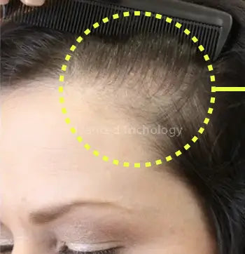 Woman’s side part before treatment, with visible thinning