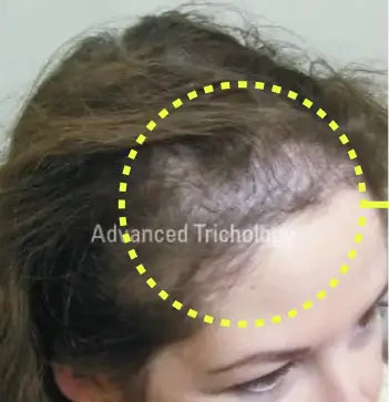 Woman’s hairline and temple before treatment, with visible thinning