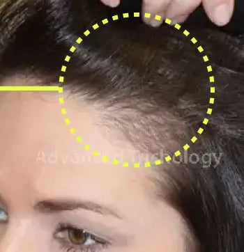 The same woman’s side part after treatment, with fuller hair