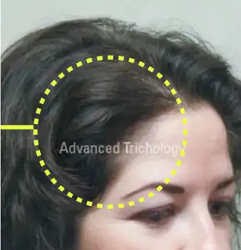 The same woman’s hairline after treatment, with fuller hair