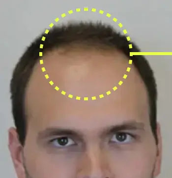Man’s receding front hairline before treatment