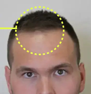The same man’s front hairline after treatment, with fuller hair