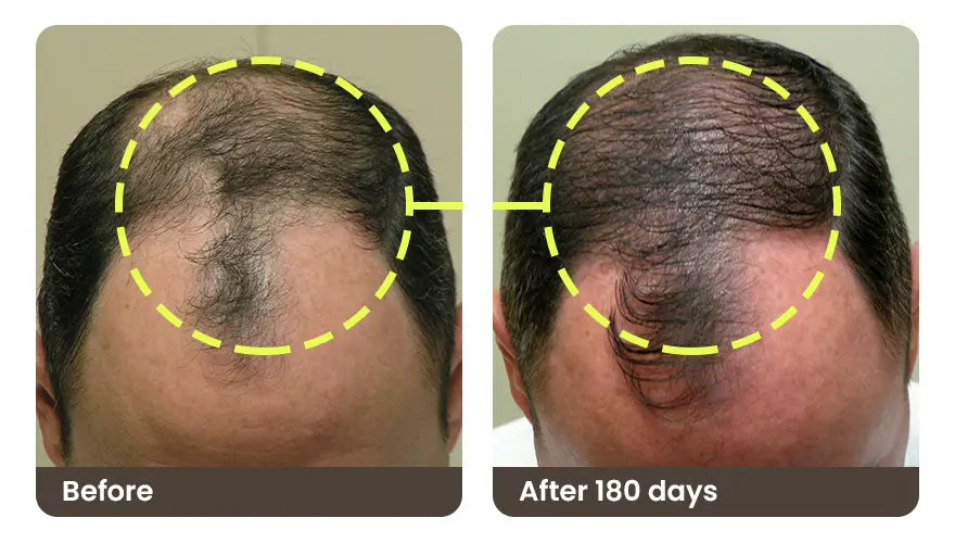 Before and after 180 days: the top of a man’s head, with a thin patch before and more coverage after
