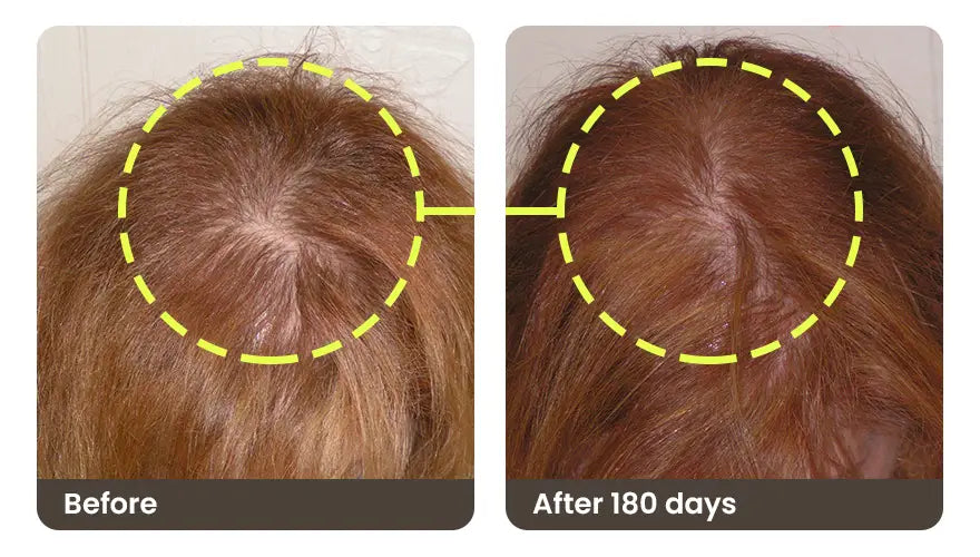 Before and after 180 days: the top of a woman’s head, with a visible part before and denser hair after