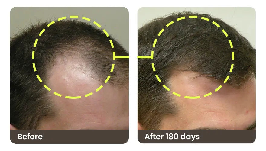 Before and after 180 days: a man’s receding temple, thinner before and fuller after