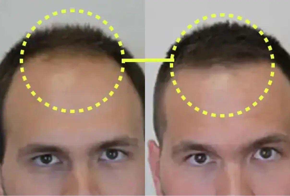 Before and after: a man’s front hairline, from thinning temples to fuller hair