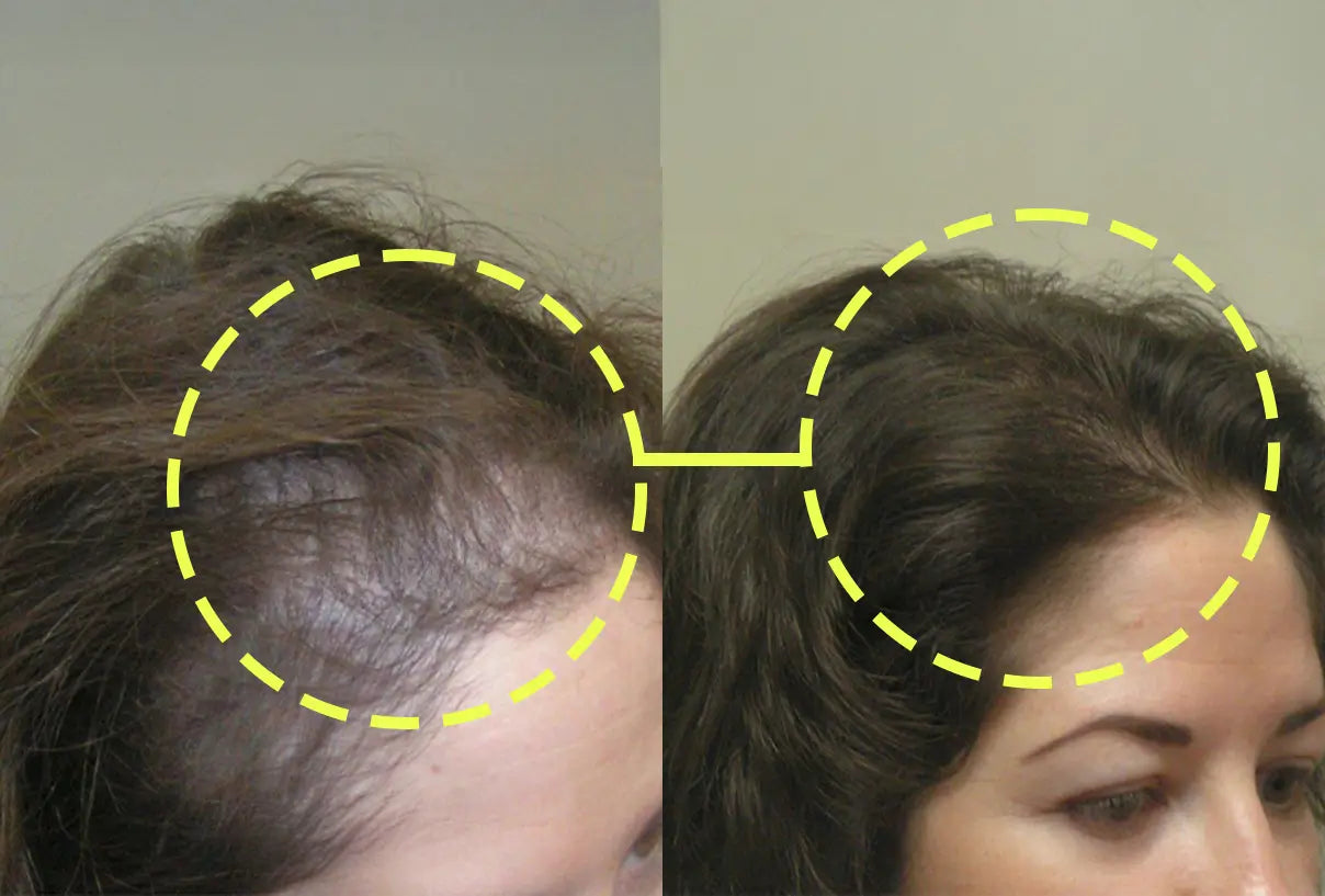 Before and after: a woman’s hairline and temple, from visible thinning to fuller hair