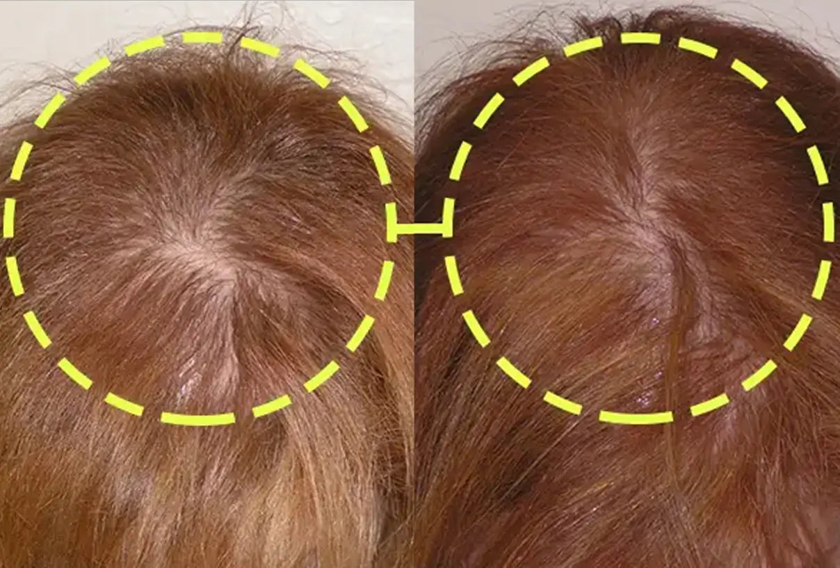 Before and after: the top of a woman’s head, from a widening part to denser hair