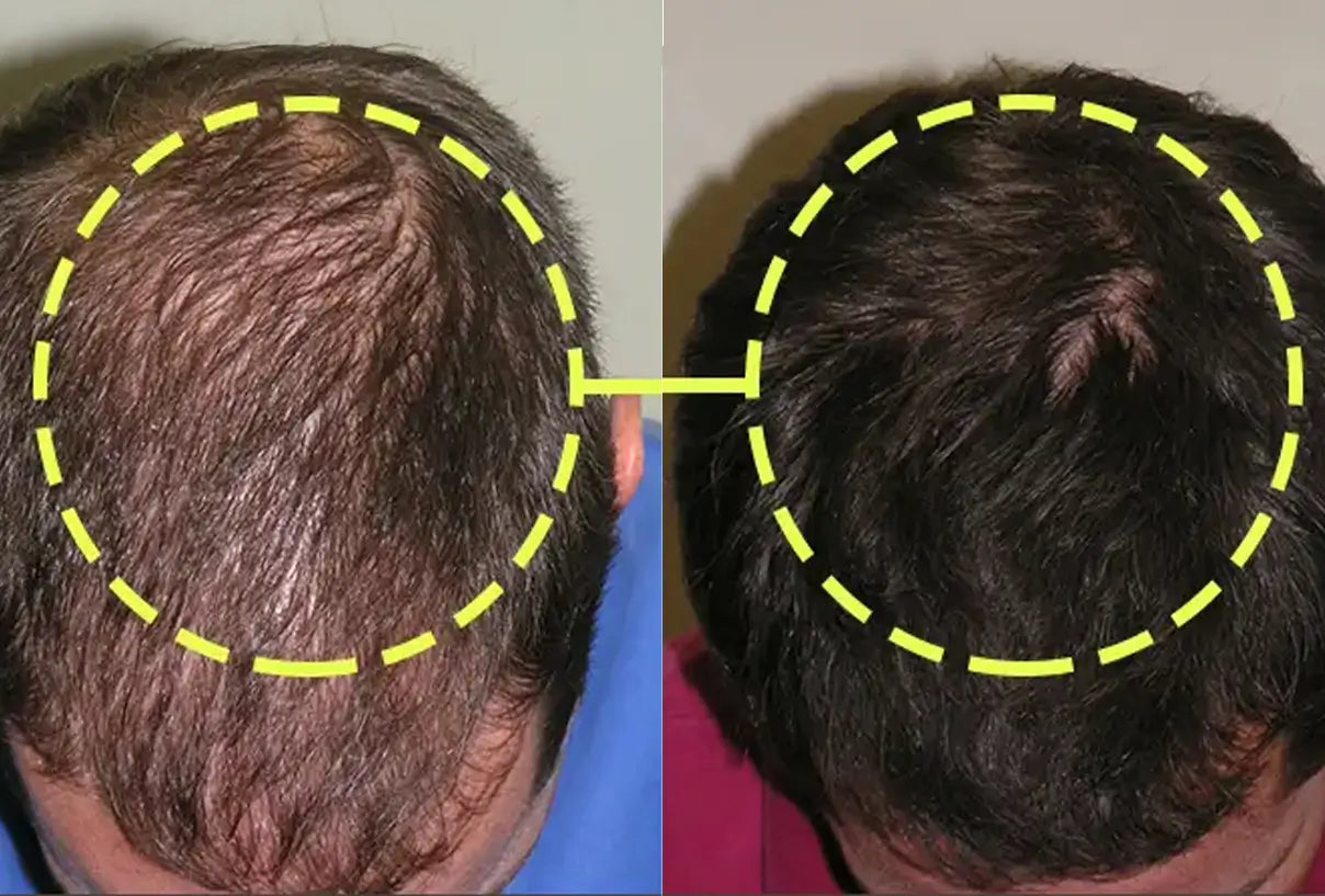 Before and after: the top of a man’s head, from a thinning crown to denser hair