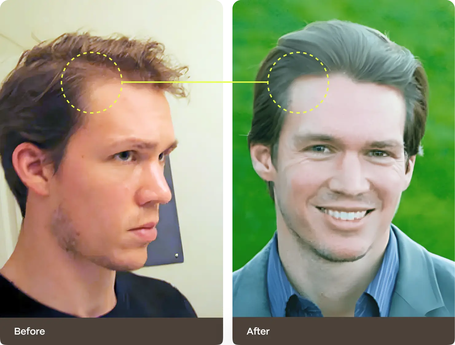 William Gaunitz before and after: a receding hairline before, a full head of hair after